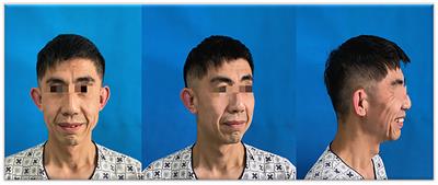 Congenital Cutis Laxa: A Case Report and Literature Review
